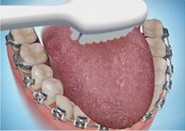 Perfect Smile ortho Brushing steps